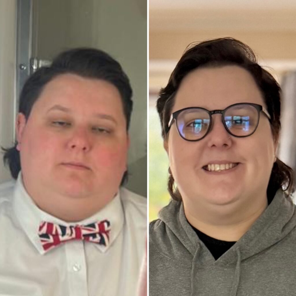 Em North 2 months after gastric bypass surgery in 2025